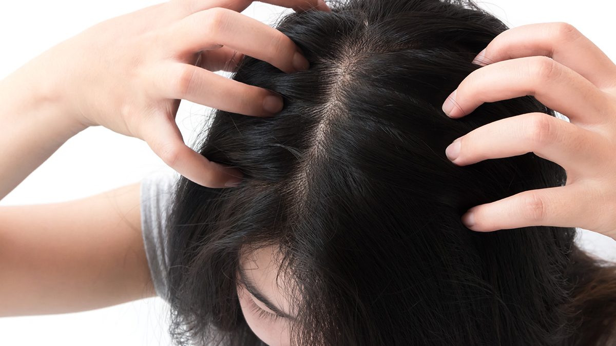 Taklukkan Ketombe dengan Bahan Alami: Rahasia Rambut Sehat dan Bersih