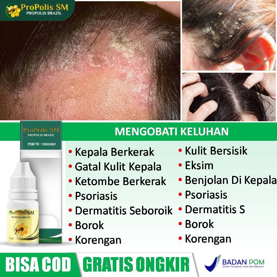 Gatal Tak Tertahankan di Kulit Kepala? Atasi dengan Cara Ini!