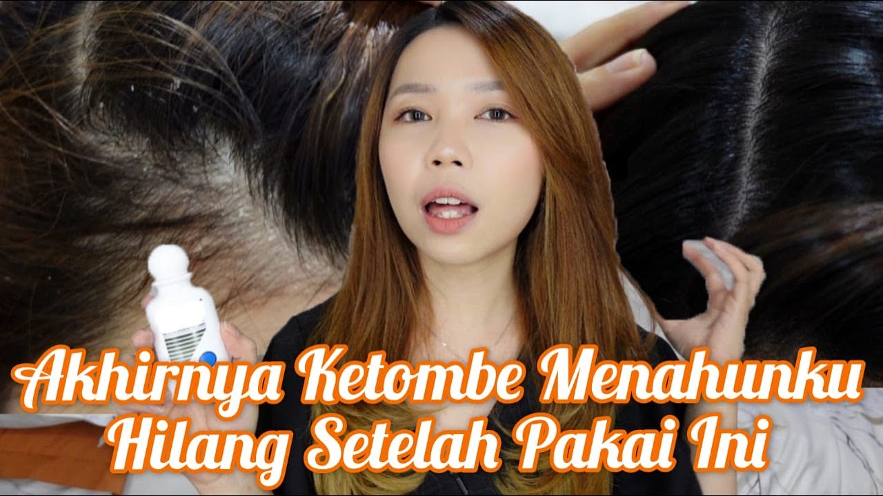 Solusi Mengatasi Kulit Kepala Gatal karena Produk Rambut: Rahasia Rambut Sehat dan Bebas Gatal