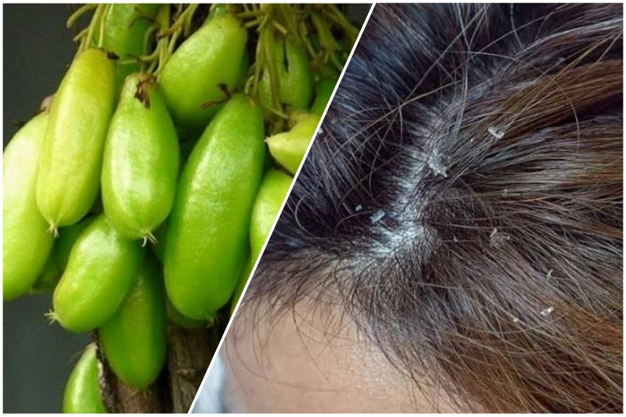 Tips Ampuh Mencegah Ketombe Kembali dengan Mudah: Rahasia Rambut Sehat dan Bersih