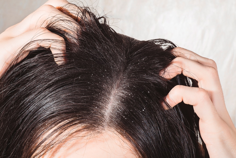 Cara Mengatasi Ketombe pada Rambut Keriting: 12 Tips untuk Rambut Bebas Ketombe