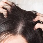 Rambut Rontok karena Ketombe? Tenang, 12 Solusi Ampuh Ini Bisa Membantu!