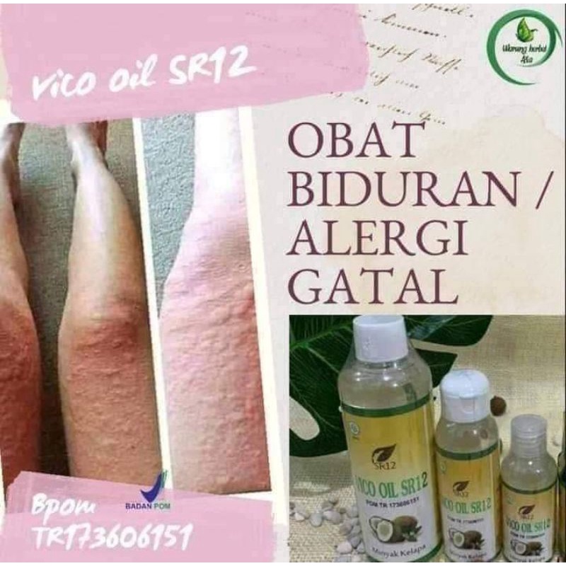 Kulit Kepala Gatal? Tenang, Ada Obat Alami yang Ampuh!