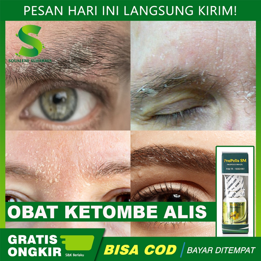 Bosan Berjibaku dengan Ketombe? Inilah Rahasia Kulit Kepala Sehat dan Bebas Ketombe!