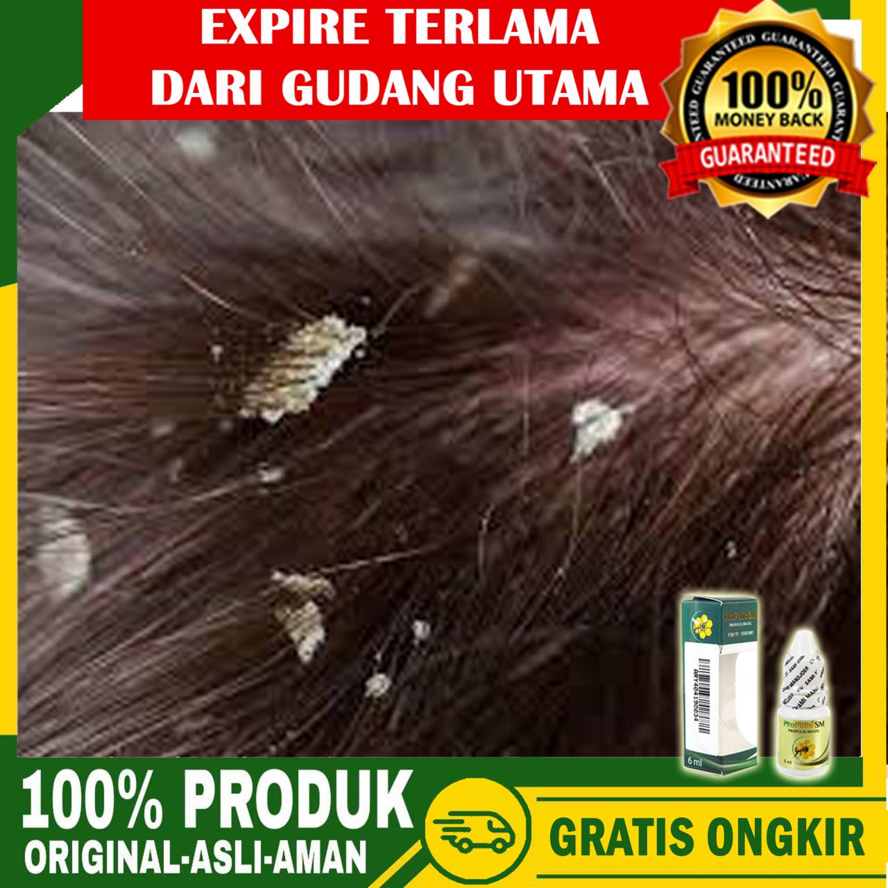 Pernahkah Anda Merasakan Gatal Tak Tertahankan di Kulit Kepala? Atasi Ketombe dan Kulit Kepala Gatal dengan Obat Herbal!