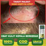 Gatal di Kepala? Atasi dengan Cara Alami yang Ampuh!