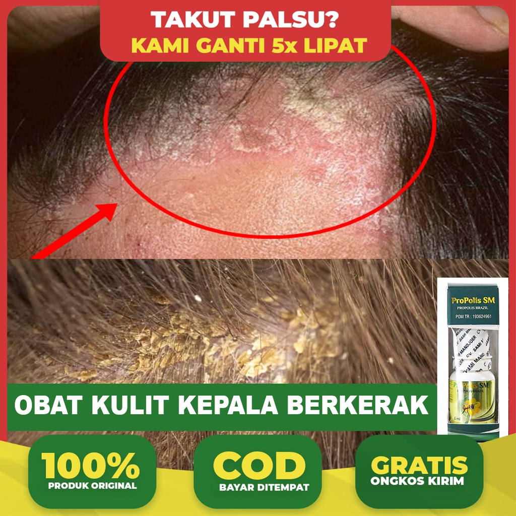 Gatal di Kepala Tak Kunjung Hilang? Mungkin Ini Faktor Genetik!