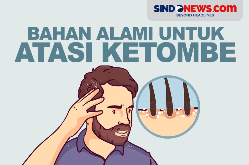 Rahasia Atasi Ketombe yang Muncul Setelah Menikah: Tak Perlu Panik, Simak Solusinya!