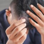 Rambut Rontok di Usia Muda: Kenapa Hal Ini Terjadi dan Apa yang Bisa Dilakukan?