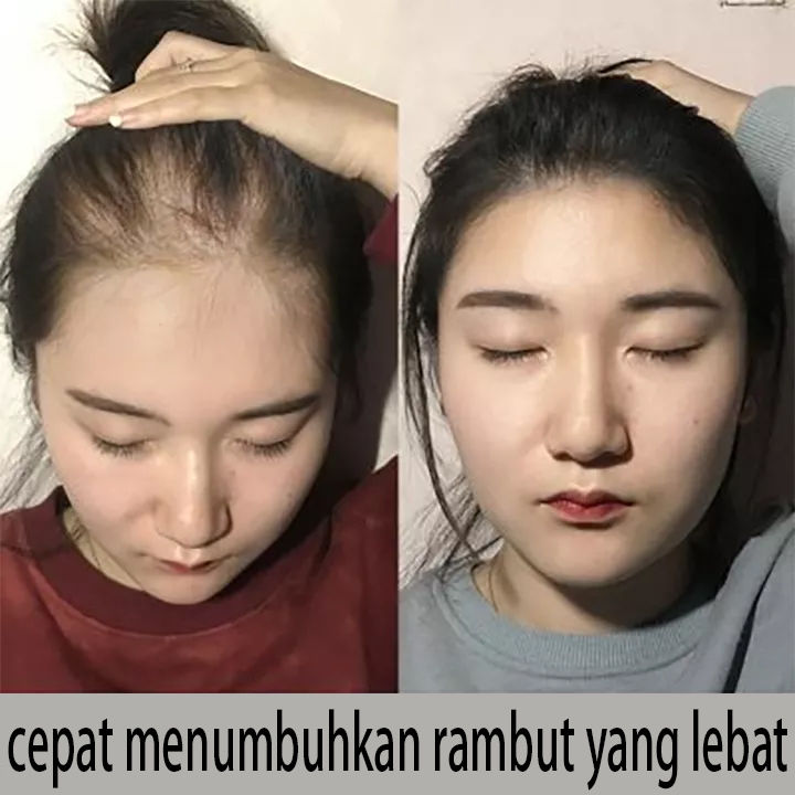 CoQ10: Nutrisi untuk Pertumbuhan Rambut yang Optimal