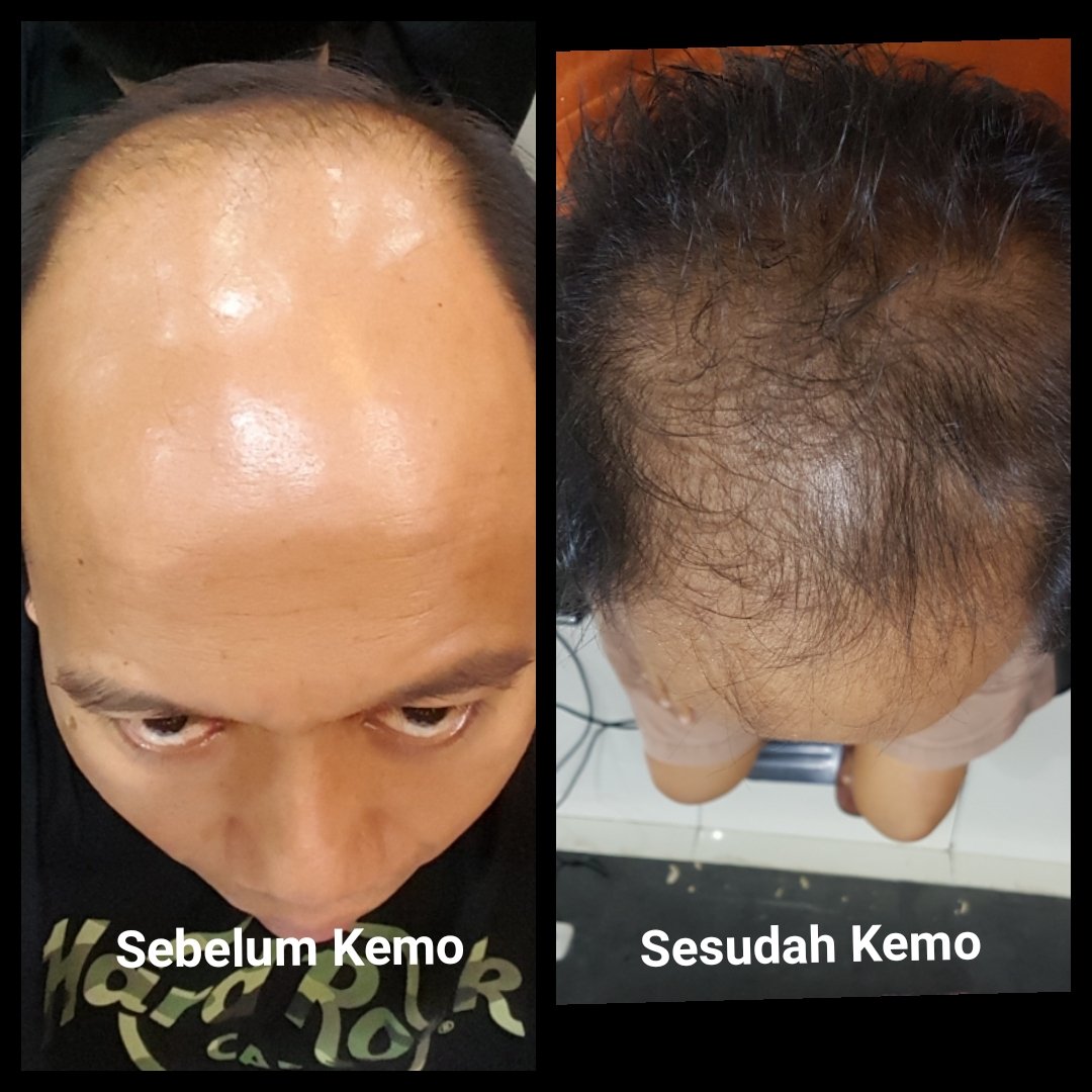 Rambut Dicabut, Apakah Akan Tumbuh Kembali?