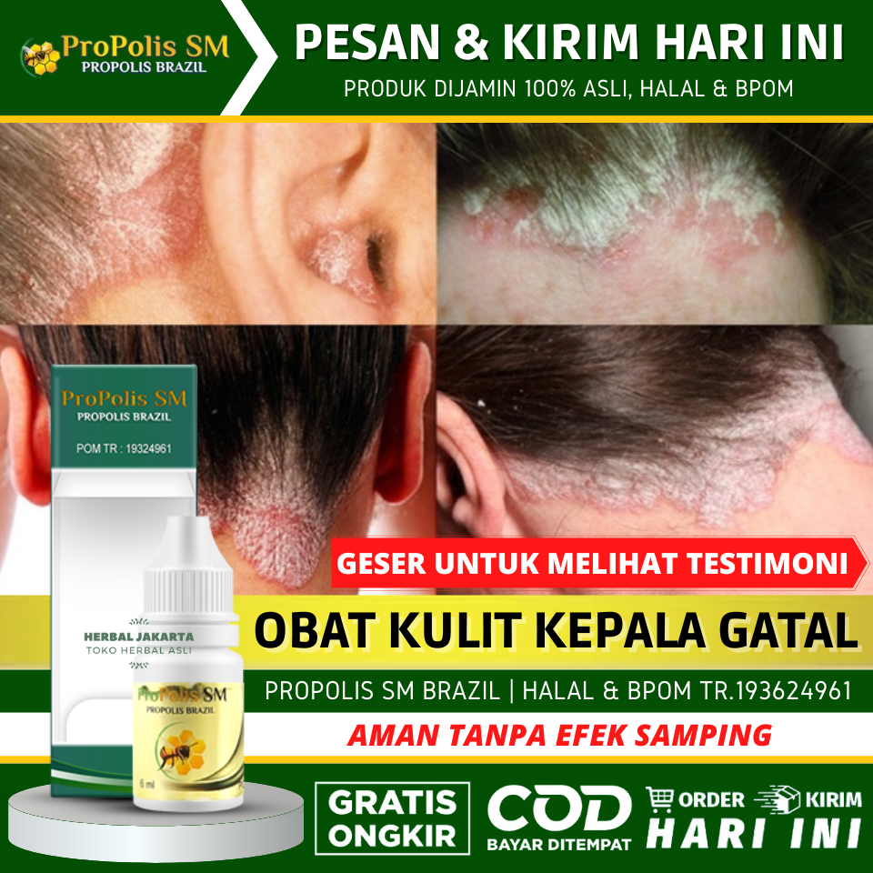 Atasi Ketombe Membandel dengan 12 Obat Alami yang Terbukti Efektif!