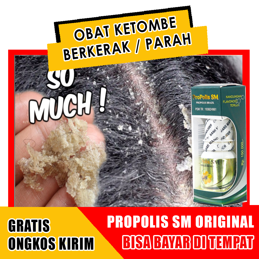 Atasi Ketombe Membandel dengan Obat Apotik yang Ampuh dan Terjangkau!