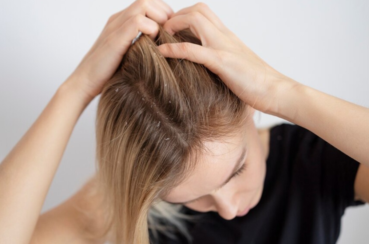 Atasi Ketombe Membandel di Rambut Keriting: Panduan Lengkap untuk Rambut Sehat dan Berkilau