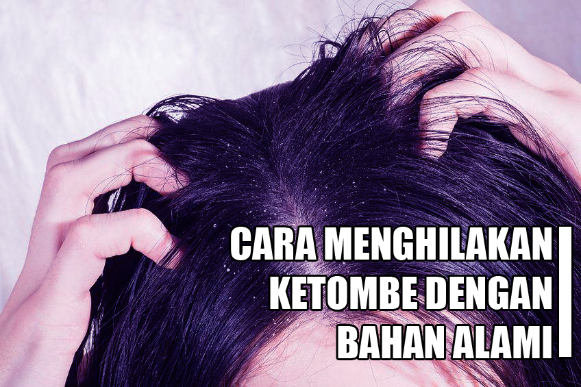 Tips Ampuh Mencegah Ketombe Kembali dengan Mudah: Rahasia Rambut Sehat dan Bersih