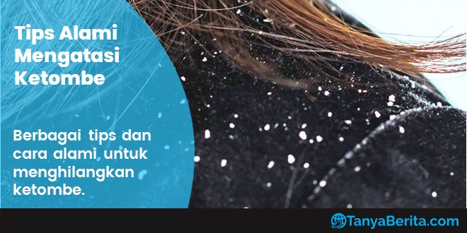 Berjuang Melawan Ketombe? Atasi Secara Alami dengan 7 Tips Ini!