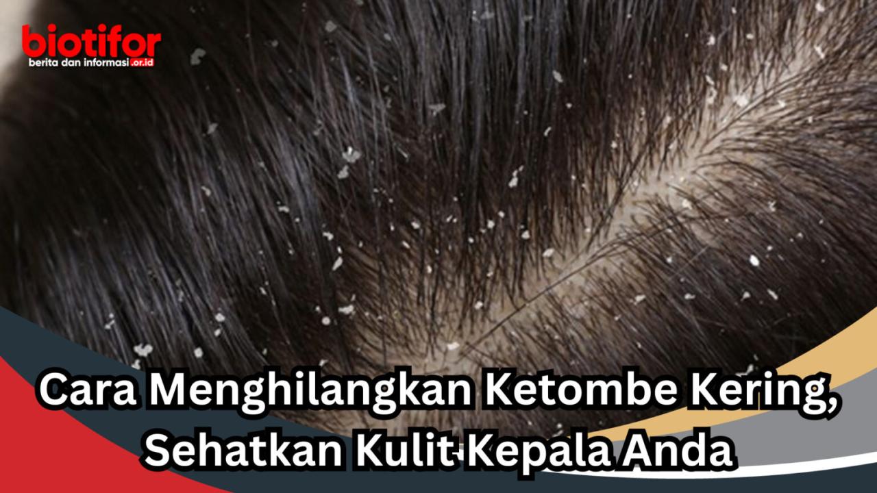 Tips Mudah Mengatasi Ketombe Agar Tidak Kembali Lagi: Selamat Tinggal, Kulit Kepala Bersisik!