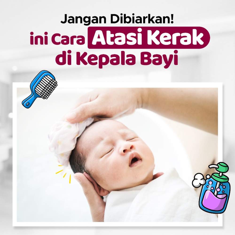 Solusi Aman Menghilangkan Ketombe pada Bayi dengan Mudah