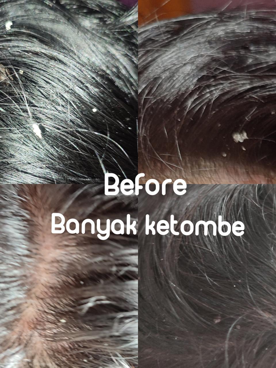 Rambut Berminyak dan Ketombe: Taklukkan Masalah Ini dengan Mudah!