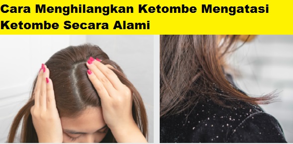 Cara Efektif Mengatasi Ketombe Akibat Infeksi: Kembalikan Kepercayaan Dirimu!