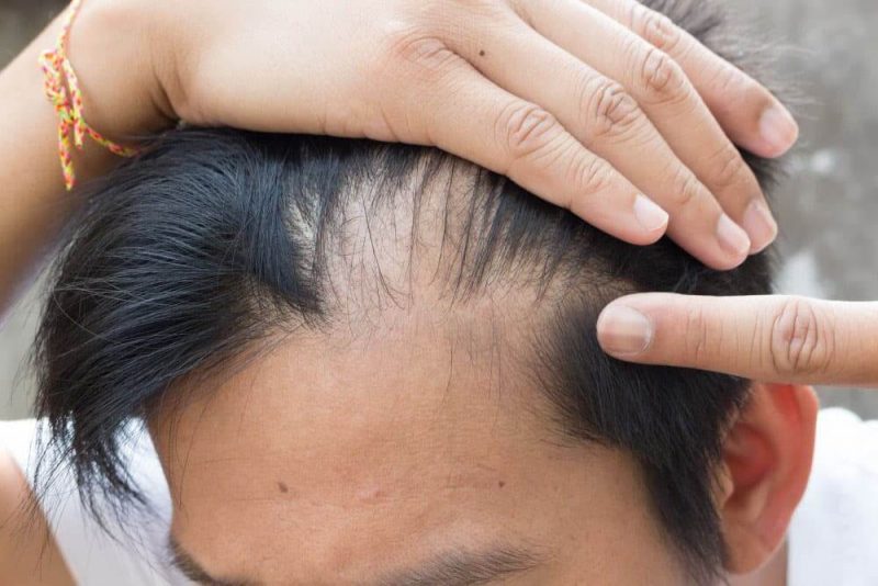 Rambut Rontok di Usia Dewasa: 12 Faktor yang Sering Terabaikan