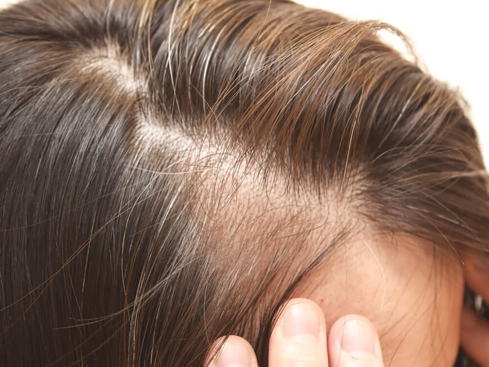 Rambut Tipis? Atasi dengan Asupan Biotin yang Tepat!