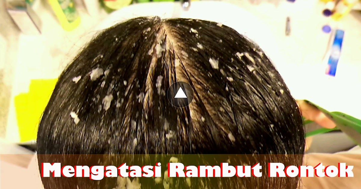 Rambut Rontok? Coba Atasi dengan Bawang Merah!