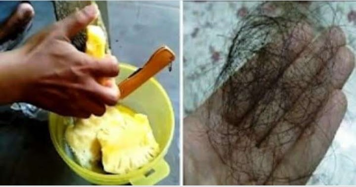 Rambut Rontok Akibat Ketombe? Tenang, Solusi Ini Efektif!