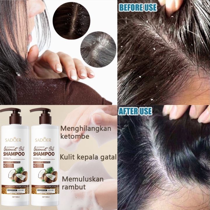 Pertempuran Melawan Ketombe Parah: Kisah Perjalanan Menuju Rambut Sehat