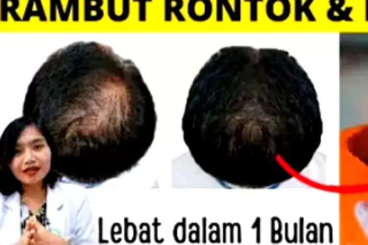 Rambut Rontok? Tenang, Ada Solusi Khusus untuk Pria!