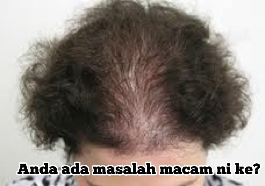 Rambut Kusam dan Lemah? Mungkin Vitamin B yang Kurang!