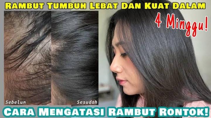 Rambut Rontok di Usia Muda? Jangan Panik! Simak Panduan Lengkap Mengatasinya