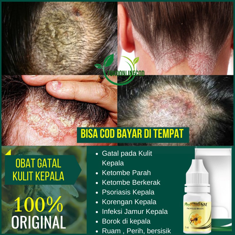 Pernahkah Anda Merasakan Gatal Tak Tertahankan di Kulit Kepala? Atasi Ketombe dan Kulit Kepala Gatal dengan Obat Herbal!