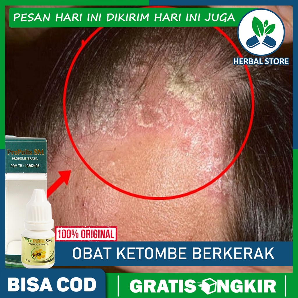 Gatal Tak Tertahankan? Atasi Kulit Kepala Gatal karena Ketombe dengan Tips Jitu Ini!