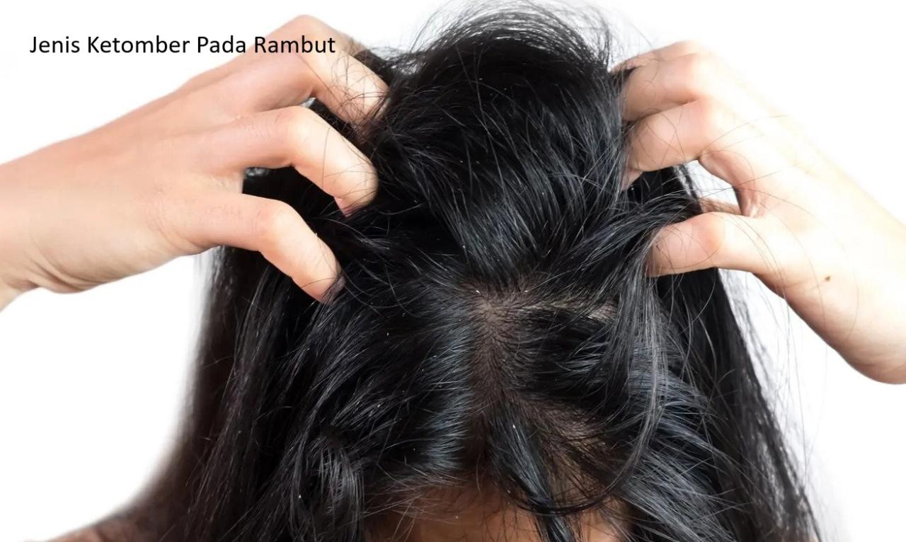 Rambut Rontok? Mungkin Kamu Kekurangan Zinc!