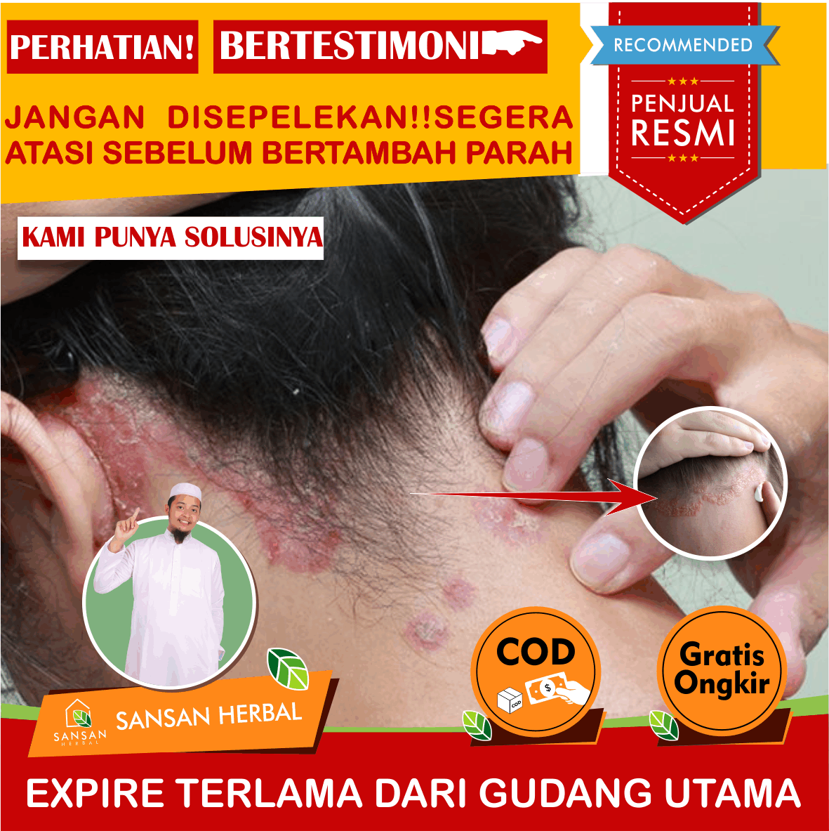 Gatal Tak Tertahankan di Kepala? Atasi Ketombe dengan Solusi Praktis Ini!