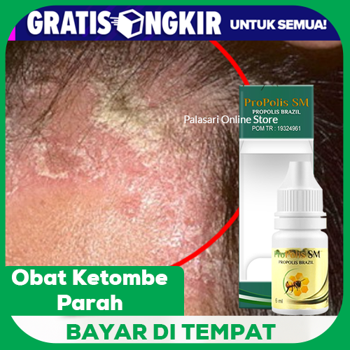 Tips Mudah Mengatasi Ketombe Agar Tidak Kembali Lagi: Selamat Tinggal, Kulit Kepala Bersisik!