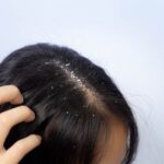 Cara Mengatasi Ketombe Kering pada Rambut: 12 Tips untuk Rambut Bebas Ketombe