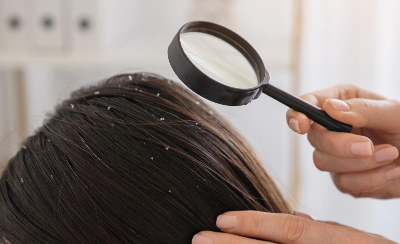 Atasi Ketombe dengan Tips dan Trik Rahasia: Rambut Sehat dan Berkilau Menanti!