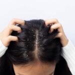 Cara Menghilangkan Ketombe pada Rambut Kering: 12 Tips Efektif untuk Hasil Maksimal