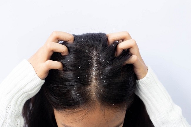 Cara Menghilangkan Ketombe pada Rambut Kering: 12 Tips Efektif untuk Hasil Maksimal