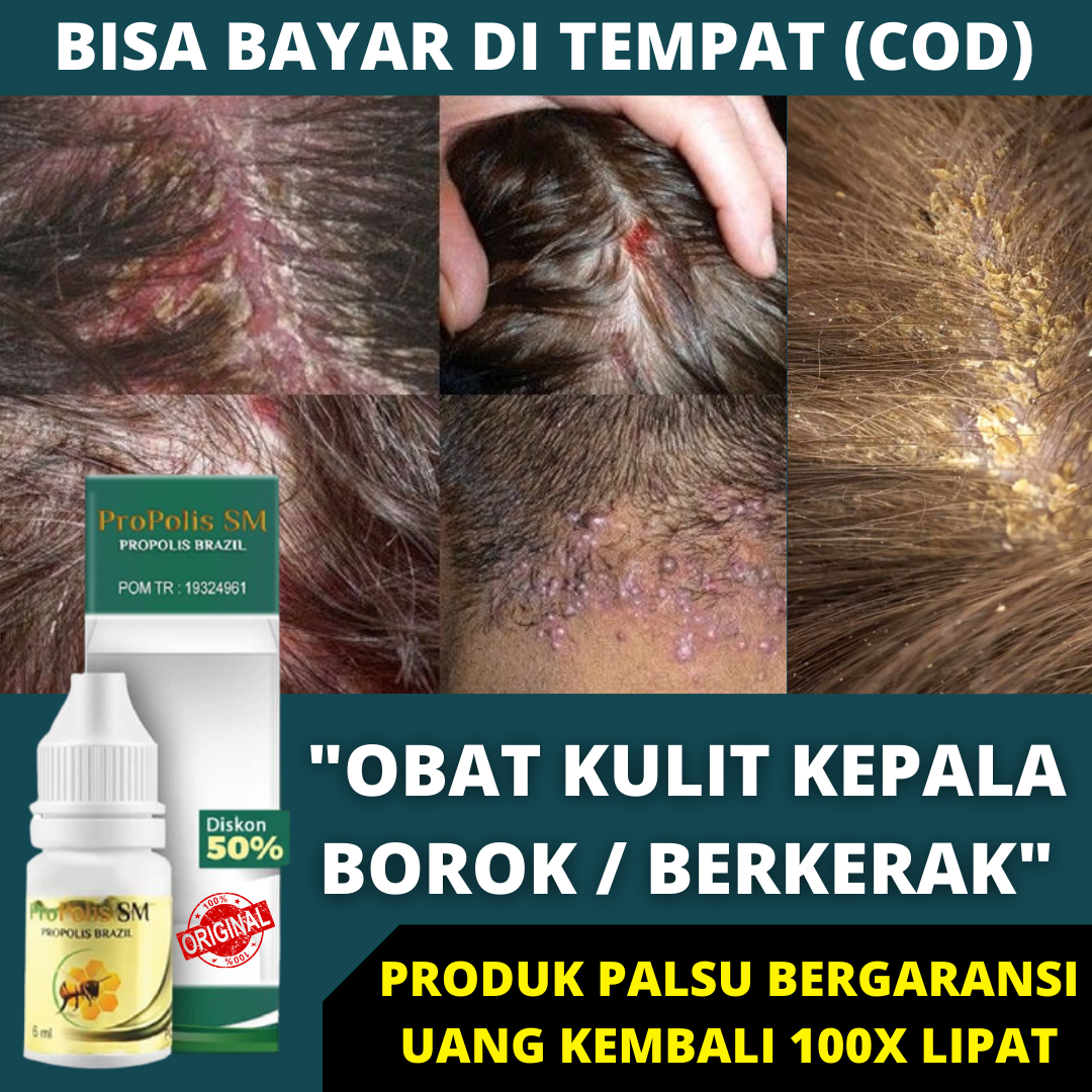 Gatal Tak Tertahankan di Kulit Kepala? Atasi dengan Cara Ini!