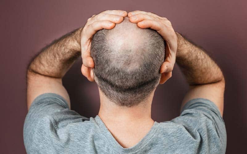 Rambut Rontok? Mungkin Vitamin B12 yang Kurang!