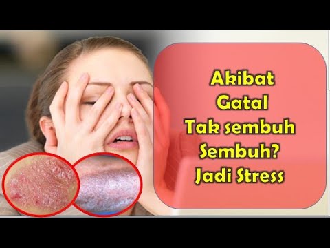 Kulit Kepala Gatal Tak Kunjung Sembuh? Waspadai Infeksi dan Atasi dengan Tepat!