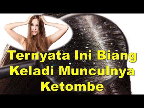 Apa Penyebab Ketombe? Ini Jawabannya!