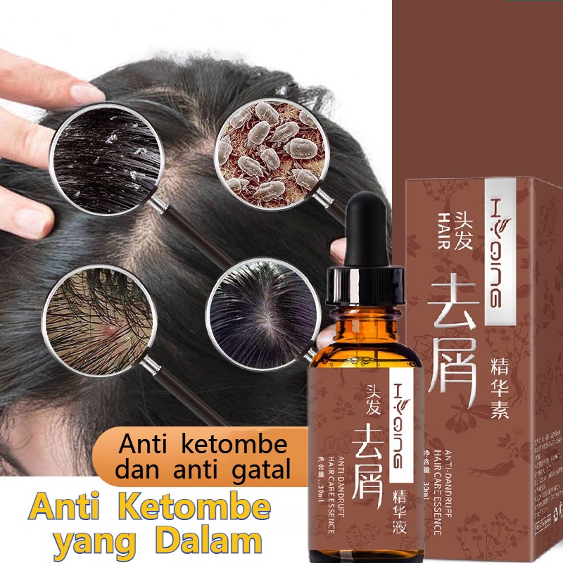 Bosan dengan Ketombe? 12 Obat Ketombe Paling Ampuh untuk Atasi Masalah Rambut Anda!