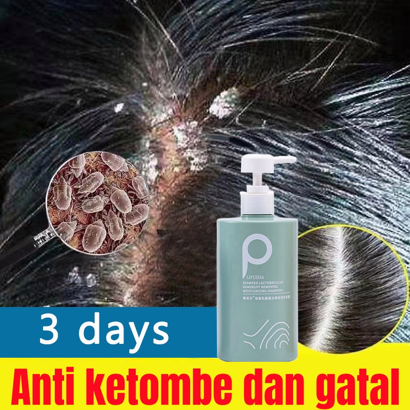 Shampoo untuk Kulit Kepala Gatal Akibat Ketombe: 12 Rekomendasi untuk Hasil Maksimal