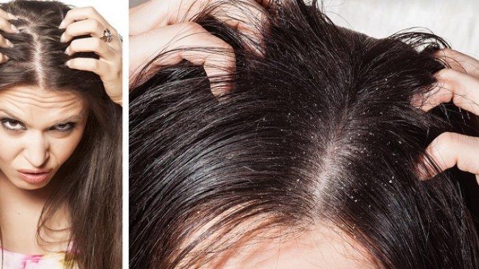 Mengelola Rambut Berminyak dengan Bahan Alami: Rahasia Rambut Segar dan Sehat