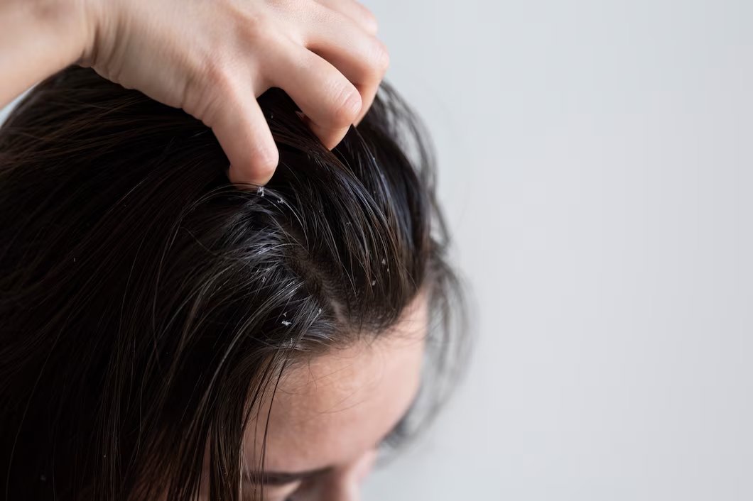 Rambut Rontok karena Tiroid? Tenang, Ada Solusinya!