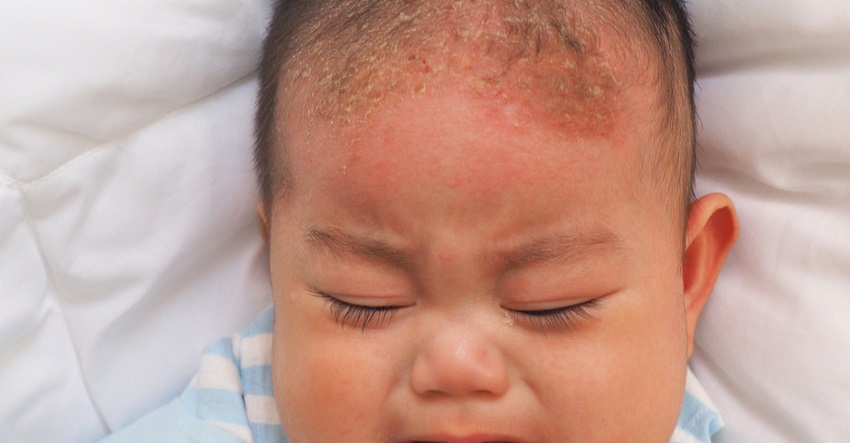 Solusi Mengatasi Kulit Kepala Gatal pada Bayi dengan Aman: Panduan Lengkap untuk Orang Tua